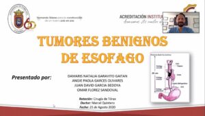 SEMINARIO: “TUMORES BENIGNOS DE ESÓFAGO: LEIOMIOMA” Estudiantes VIII Semestre Medicina UPA. 21/08/2020