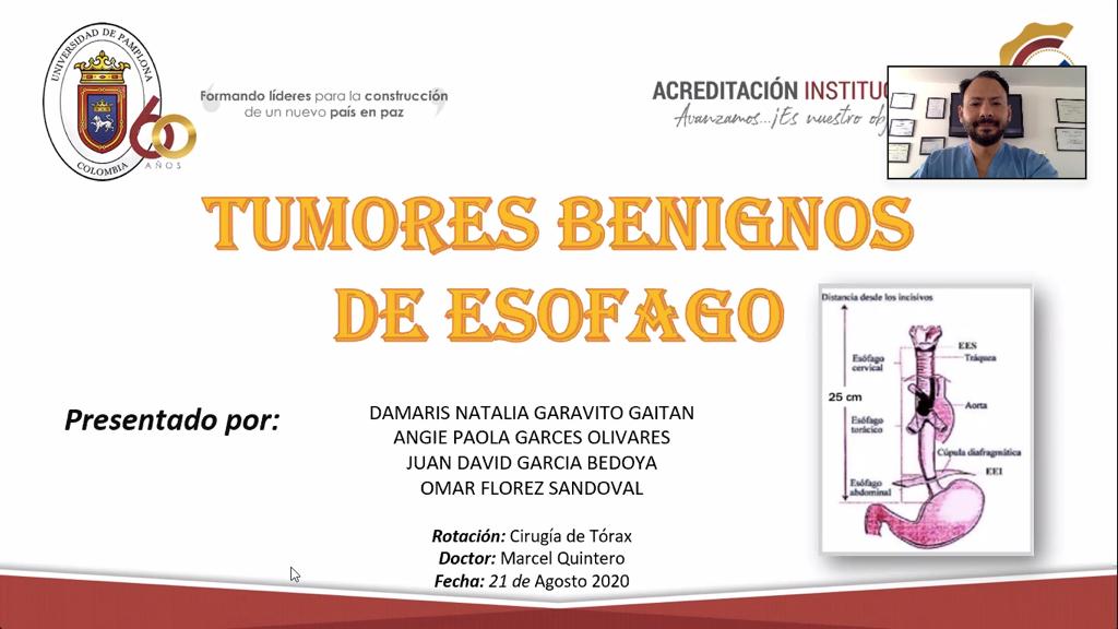 SEMINARIO: “TUMORES BENIGNOS DE ESÓFAGO: LEIOMIOMA” Estudiantes VIII Semestre Medicina UPA. 21/08/2020