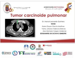CIERRE DE SEMANA CONTRA EL CÁNCER PULMONAR: “TUMOR CARCINOIDE PULMONAR “ ESTUDIANTES 8 SEMESTRE UPA. Mañana 7:00 am, INVITADISIMOS!!!