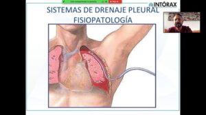 CLASE: “TORACOSTOMIA Y SISTEMA DE DRENAJE PLEURAL(SDP)” Estudiantes VIII Semestre UPA, IX Semestre UBosque. 1/02/2021 @unipamplona @departamentodemedicina @uelbosque @intorax.cucuta–