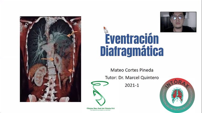 PRESENTACIÓN: “EVENTRACIÓN DIAGRAMÁTICA” Rotación Electiva Internado Clínica San José de Cúcuta, UNICORPAS. 26/02/2021 @intorax.cucuta @unicorpas @mattt.cp @clinicasanjosecuc