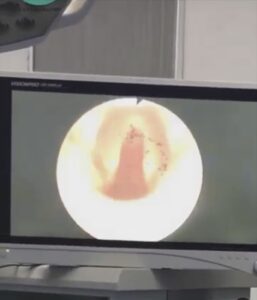 INDISCUTIBLE, EL MEJOR RESULTADO! ANTES Y DESPUÉS DE LA RECONSTRUCCIÓN TRAQUEAL POR ESTENOSIS ASOCIADA A COVID-19