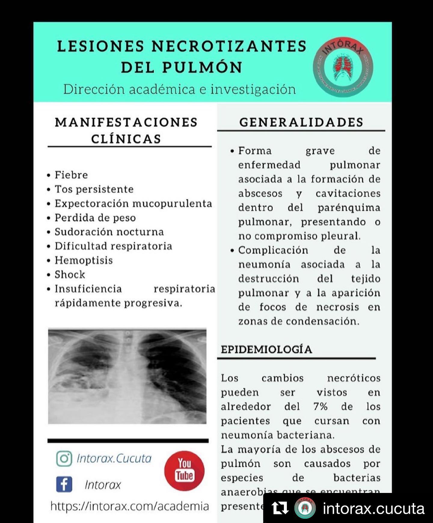 Píldora&nbsp;<img height="16" width="16" alt="💊" src="https://static.xx.fbcdn.net/images/emoji.php/v9/tf5/1/16/1f48a.png">&nbsp;académica de la semana:<br>Todo el contenido académico disponible en&nbsp;<a href="http://www.intorax.com/?fbclid=IwAR0CAPdPYtXVpfFYwWMZfRVmSRoAtP_zQKqHgReJA6Z1az5RrgoJnHQmitI" rel="noreferrer noopener" target="_blank">www.intorax.com</a>&nbsp;/ academia&nbsp;<a href="https://www.facebook.com/hashtag/intoraxesdesarrollocient%C3%ADfico?__eep__=6&__cft__[0]=AZVX4yO8R5T4HZrlyIfgv8R4HFTwpJChlNzBFh02LQkIwWVMXrCBluTqhkijZhBPpLS3npP0ibRbJkXvOUDv4YqNXx4HE0PT77RACnwXl02JNSvEZ84SiXchQ8j__WI9DHYF1NPL_fYjDCthbjORmYWd&__tn__=*NK*F">#intoraxesdesarrollocientífico</a>&nbsp;@intorax.cucuta