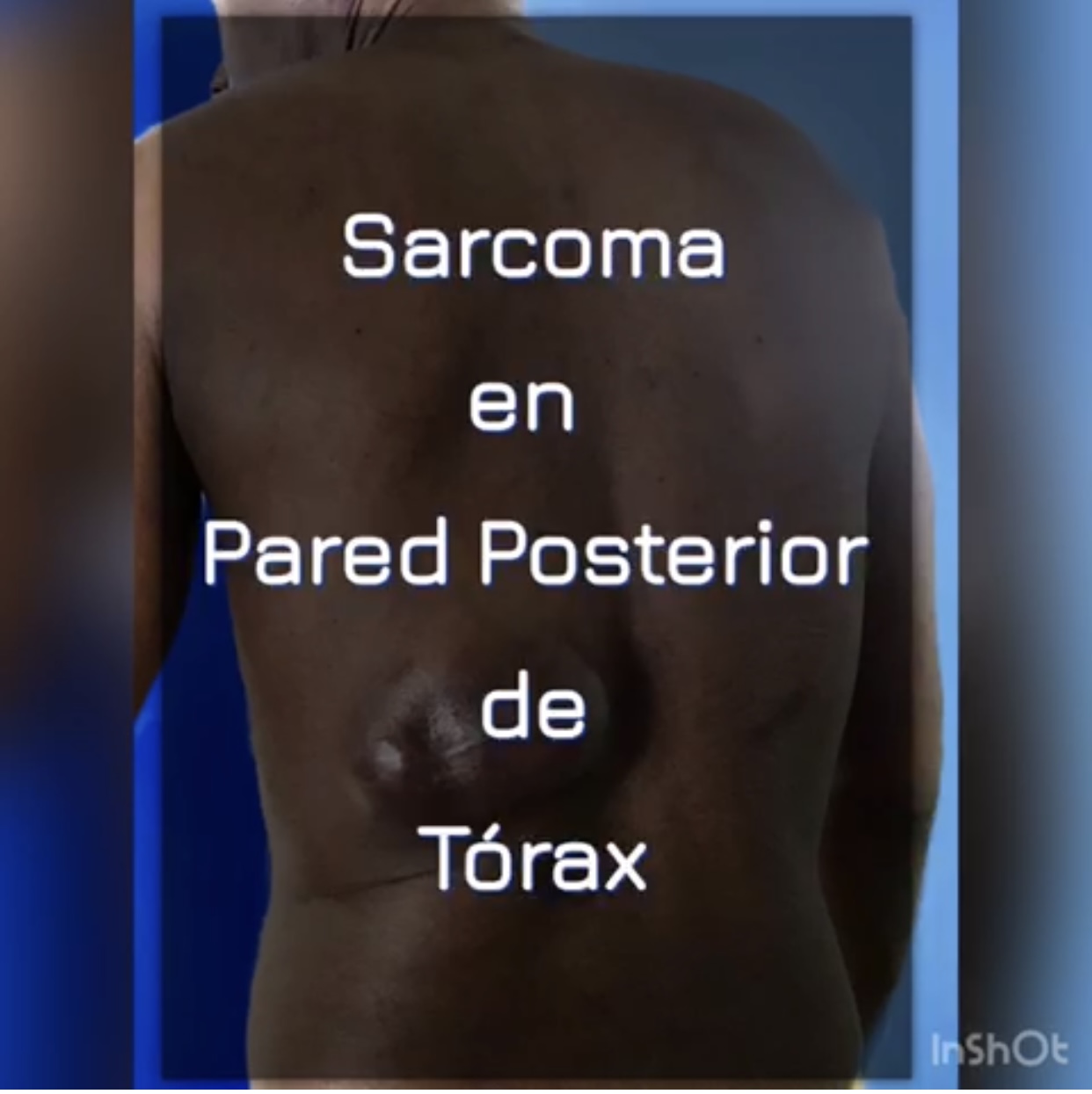 Publicación con propósito educativo en el campo de la Medicina, Cirugía, Cirugía de Tórax y Cirugía Plástica Reconstructiva.El sarcoma es un tipo de cáncer que empieza en ciertas partes del cuerpo como los huesos o los músculos. Aquí nos referimos a sarcomas de tejido blando en adultos. Estos cánceres se originan en tejidos blandos como grasas, músculos, nervios, tejidos fibrosos, vasos sanguíneos o tejidos profundos de la piel. Se realiza resección con márgenes oncológicos por parte del servicio de Cirugía de Tórax, y reconstrucción inmediata por el servicio de Cirugía Plástica mediante colgajo Músculo Cutáneo de Dorsal Ancho @drerickfigueroaguerra @erickfiguerra @quintero.marcel @dragiselapuentes
