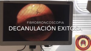 Decanulación de Traqueostomia por fibrobroncoscopia permite seguridad y éxito, diagnósticos diferenciales y coexistentes!  Por Cirujano Torácico.
