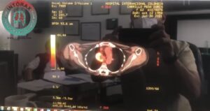 PET/CT Tomografía por emisión de positrones-Tomografía Computada en Cáncer Pulmonar; análisis y aplicaciones por Cirujano Torácico.@intorax.cucuta <a href="https://www.facebook.com/hashtag/cancer?__eep__=6&__cft__[0]=AZUPTgPSbodwvg4Dwscoeo7UBaLCpAtt960KUntWjvB2onWIzqAO7No_OkcZAYszFK9QGSEY69vZB7LLAO32Uki0KPFqaUEarD3uVjYL38ulXFGVxQLoen7T9pOi7eNxNH8yymL5nV7vAaCICUz2kLAolSta7V0swO6umCCTg8QNRg&__tn__=*NK-R">#cancer</a><a href="https://www.facebook.com/hashtag/cancerpulmonar?__eep__=6&__cft__[0]=AZUPTgPSbodwvg4Dwscoeo7UBaLCpAtt960KUntWjvB2onWIzqAO7No_OkcZAYszFK9QGSEY69vZB7LLAO32Uki0KPFqaUEarD3uVjYL38ulXFGVxQLoen7T9pOi7eNxNH8yymL5nV7vAaCICUz2kLAolSta7V0swO6umCCTg8QNRg&__tn__=*NK-R">#cancerpulmonar</a><a href="https://www.facebook.com/hashtag/pulmon?__eep__=6&__cft__[0]=AZUPTgPSbodwvg4Dwscoeo7UBaLCpAtt960KUntWjvB2onWIzqAO7No_OkcZAYszFK9QGSEY69vZB7LLAO32Uki0KPFqaUEarD3uVjYL38ulXFGVxQLoen7T9pOi7eNxNH8yymL5nV7vAaCICUz2kLAolSta7V0swO6umCCTg8QNRg&__tn__=*NK-R">#pulmon</a><a href="https://www.facebook.com/hashtag/medicina?__eep__=6&__cft__[0]=AZUPTgPSbodwvg4Dwscoeo7UBaLCpAtt960KUntWjvB2onWIzqAO7No_OkcZAYszFK9QGSEY69vZB7LLAO32Uki0KPFqaUEarD3uVjYL38ulXFGVxQLoen7T9pOi7eNxNH8yymL5nV7vAaCICUz2kLAolSta7V0swO6umCCTg8QNRg&__tn__=*NK-R">#medicina</a><a href="https://www.facebook.com/hashtag/cirugia?__eep__=6&__cft__[0]=AZUPTgPSbodwvg4Dwscoeo7UBaLCpAtt960KUntWjvB2onWIzqAO7No_OkcZAYszFK9QGSEY69vZB7LLAO32Uki0KPFqaUEarD3uVjYL38ulXFGVxQLoen7T9pOi7eNxNH8yymL5nV7vAaCICUz2kLAolSta7V0swO6umCCTg8QNRg&__tn__=*NK-R">#cirugia</a><a href="https://www.facebook.com/hashtag/toracoscopia?__eep__=6&__cft__[0]=AZUPTgPSbodwvg4Dwscoeo7UBaLCpAtt960KUntWjvB2onWIzqAO7No_OkcZAYszFK9QGSEY69vZB7LLAO32Uki0KPFqaUEarD3uVjYL38ulXFGVxQLoen7T9pOi7eNxNH8yymL5nV7vAaCICUz2kLAolSta7V0swO6umCCTg8QNRg&__tn__=*NK-R">#toracoscopia</a><a href="https://www.facebook.com/hashtag/vats?__eep__=6&__cft__[0]=AZUPTgPSbodwvg4Dwscoeo7UBaLCpAtt960KUntWjvB2onWIzqAO7No_OkcZAYszFK9QGSEY69vZB7LLAO32Uki0KPFqaUEarD3uVjYL38ulXFGVxQLoen7T9pOi7eNxNH8yymL5nV7vAaCICUz2kLAolSta7V0swO6umCCTg8QNRg&__tn__=*NK-R">#VATS</a><a href="https://www.facebook.com/hashtag/cirugiadeltorax?__eep__=6&__cft__[0]=AZUPTgPSbodwvg4Dwscoeo7UBaLCpAtt960KUntWjvB2onWIzqAO7No_OkcZAYszFK9QGSEY69vZB7LLAO32Uki0KPFqaUEarD3uVjYL38ulXFGVxQLoen7T9pOi7eNxNH8yymL5nV7vAaCICUz2kLAolSta7V0swO6umCCTg8QNRg&__tn__=*NK-R">#cirugiadeltorax</a><a href="https://www.facebook.com/hashtag/cirugiadetorax?__eep__=6&__cft__[0]=AZUPTgPSbodwvg4Dwscoeo7UBaLCpAtt960KUntWjvB2onWIzqAO7No_OkcZAYszFK9QGSEY69vZB7LLAO32Uki0KPFqaUEarD3uVjYL38ulXFGVxQLoen7T9pOi7eNxNH8yymL5nV7vAaCICUz2kLAolSta7V0swO6umCCTg8QNRg&__tn__=*NK-R">#cirugiadetorax</a><a href="https://www.facebook.com/hashtag/marcelquintero?__eep__=6&__cft__[0]=AZUPTgPSbodwvg4Dwscoeo7UBaLCpAtt960KUntWjvB2onWIzqAO7No_OkcZAYszFK9QGSEY69vZB7LLAO32Uki0KPFqaUEarD3uVjYL38ulXFGVxQLoen7T9pOi7eNxNH8yymL5nV7vAaCICUz2kLAolSta7V0swO6umCCTg8QNRg&__tn__=*NK-R">#marcelquintero</a><a href="https://www.facebook.com/hashtag/intorax?__eep__=6&__cft__[0]=AZUPTgPSbodwvg4Dwscoeo7UBaLCpAtt960KUntWjvB2onWIzqAO7No_OkcZAYszFK9QGSEY69vZB7LLAO32Uki0KPFqaUEarD3uVjYL38ulXFGVxQLoen7T9pOi7eNxNH8yymL5nV7vAaCICUz2kLAolSta7V0swO6umCCTg8QNRg&__tn__=*NK-R">#intorax</a><a href="https://www.facebook.com/hashtag/huem?__eep__=6&__cft__[0]=AZUPTgPSbodwvg4Dwscoeo7UBaLCpAtt960KUntWjvB2onWIzqAO7No_OkcZAYszFK9QGSEY69vZB7LLAO32Uki0KPFqaUEarD3uVjYL38ulXFGVxQLoen7T9pOi7eNxNH8yymL5nV7vAaCICUz2kLAolSta7V0swO6umCCTg8QNRg&__tn__=*NK-R">#huem</a><a href="https://www.facebook.com/hashtag/csj?__eep__=6&__cft__[0]=AZUPTgPSbodwvg4Dwscoeo7UBaLCpAtt960KUntWjvB2onWIzqAO7No_OkcZAYszFK9QGSEY69vZB7LLAO32Uki0KPFqaUEarD3uVjYL38ulXFGVxQLoen7T9pOi7eNxNH8yymL5nV7vAaCICUz2kLAolSta7V0swO6umCCTg8QNRg&__tn__=*NK-R">#csj</a><a href="https://www.facebook.com/hashtag/csa?__eep__=6&__cft__[0]=AZUPTgPSbodwvg4Dwscoeo7UBaLCpAtt960KUntWjvB2onWIzqAO7No_OkcZAYszFK9QGSEY69vZB7LLAO32Uki0KPFqaUEarD3uVjYL38ulXFGVxQLoen7T9pOi7eNxNH8yymL5nV7vAaCICUz2kLAolSta7V0swO6umCCTg8QNRg&__tn__=*NK-R">#csa</a><a href="https://www.facebook.com/hashtag/cn?__eep__=6&__cft__[0]=AZUPTgPSbodwvg4Dwscoeo7UBaLCpAtt960KUntWjvB2onWIzqAO7No_OkcZAYszFK9QGSEY69vZB7LLAO32Uki0KPFqaUEarD3uVjYL38ulXFGVxQLoen7T9pOi7eNxNH8yymL5nV7vAaCICUz2kLAolSta7V0swO6umCCTg8QNRg&__tn__=*NK-R">#cn</a> #cucuta <a href="https://www.facebook.com/hashtag/cmq?__eep__=6&__cft__[0]=AZUPTgPSbodwvg4Dwscoeo7UBaLCpAtt960KUntWjvB2onWIzqAO7No_OkcZAYszFK9QGSEY69vZB7LLAO32Uki0KPFqaUEarD3uVjYL38ulXFGVxQLoen7T9pOi7eNxNH8yymL5nV7vAaCICUz2kLAolSta7V0swO6umCCTg8QNRg&__tn__=*NK-R">#cmq</a><a href="https://www.facebook.com/hashtag/nortedesantander?__eep__=6&__cft__[0]=AZUPTgPSbodwvg4Dwscoeo7UBaLCpAtt960KUntWjvB2onWIzqAO7No_OkcZAYszFK9QGSEY69vZB7LLAO32Uki0KPFqaUEarD3uVjYL38ulXFGVxQLoen7T9pOi7eNxNH8yymL5nV7vAaCICUz2kLAolSta7V0swO6umCCTg8QNRg&__tn__=*NK-R">#nortedesantander</a><a href="https://www.facebook.com/hashtag/turismomedico?__eep__=6&__cft__[0]=AZUPTgPSbodwvg4Dwscoeo7UBaLCpAtt960KUntWjvB2onWIzqAO7No_OkcZAYszFK9QGSEY69vZB7LLAO32Uki0KPFqaUEarD3uVjYL38ulXFGVxQLoen7T9pOi7eNxNH8yymL5nV7vAaCICUz2kLAolSta7V0swO6umCCTg8QNRg&__tn__=*NK-R">#turismomedico</a><a href="https://www.facebook.com/hashtag/cucuta?__eep__=6&__cft__[0]=AZUPTgPSbodwvg4Dwscoeo7UBaLCpAtt960KUntWjvB2onWIzqAO7No_OkcZAYszFK9QGSEY69vZB7LLAO32Uki0KPFqaUEarD3uVjYL38ulXFGVxQLoen7T9pOi7eNxNH8yymL5nV7vAaCICUz2kLAolSta7V0swO6umCCTg8QNRg&__tn__=*NK-R">#cucuta</a><a href="https://www.facebook.com/hashtag/cucutaeslomio?__eep__=6&__cft__[0]=AZUPTgPSbodwvg4Dwscoeo7UBaLCpAtt960KUntWjvB2onWIzqAO7No_OkcZAYszFK9QGSEY69vZB7LLAO32Uki0KPFqaUEarD3uVjYL38ulXFGVxQLoen7T9pOi7eNxNH8yymL5nV7vAaCICUz2kLAolSta7V0swO6umCCTg8QNRg&__tn__=*NK-R">#cucutaeslomio</a><a href="https://www.facebook.com/hashtag/colombia?__eep__=6&__cft__[0]=AZUPTgPSbodwvg4Dwscoeo7UBaLCpAtt960KUntWjvB2onWIzqAO7No_OkcZAYszFK9QGSEY69vZB7LLAO32Uki0KPFqaUEarD3uVjYL38ulXFGVxQLoen7T9pOi7eNxNH8yymL5nV7vAaCICUz2kLAolSta7V0swO6umCCTg8QNRg&__tn__=*NK-R">#colombia</a><a href="https://www.facebook.com/hashtag/cucutaescirugiadeltorax?__eep__=6&__cft__[0]=AZUPTgPSbodwvg4Dwscoeo7UBaLCpAtt960KUntWjvB2onWIzqAO7No_OkcZAYszFK9QGSEY69vZB7LLAO32Uki0KPFqaUEarD3uVjYL38ulXFGVxQLoen7T9pOi7eNxNH8yymL5nV7vAaCICUz2kLAolSta7V0swO6umCCTg8QNRg&__tn__=*NK-R">#cucutaescirugiadeltorax</a><a href="https://www.facebook.com/hashtag/cucutaescirugiadetorax?__eep__=6&__cft__[0]=AZUPTgPSbodwvg4Dwscoeo7UBaLCpAtt960KUntWjvB2onWIzqAO7No_OkcZAYszFK9QGSEY69vZB7LLAO32Uki0KPFqaUEarD3uVjYL38ulXFGVxQLoen7T9pOi7eNxNH8yymL5nV7vAaCICUz2kLAolSta7V0swO6umCCTg8QNRg&__tn__=*NK-R">#cucutaescirugiadetorax</a><a href="https://www.facebook.com/hashtag/vatscucuta?__eep__=6&__cft__[0]=AZUPTgPSbodwvg4Dwscoeo7UBaLCpAtt960KUntWjvB2onWIzqAO7No_OkcZAYszFK9QGSEY69vZB7LLAO32Uki0KPFqaUEarD3uVjYL38ulXFGVxQLoen7T9pOi7eNxNH8yymL5nV7vAaCICUz2kLAolSta7V0swO6umCCTg8QNRg&__tn__=*NK-R">#Vatscucuta</a>