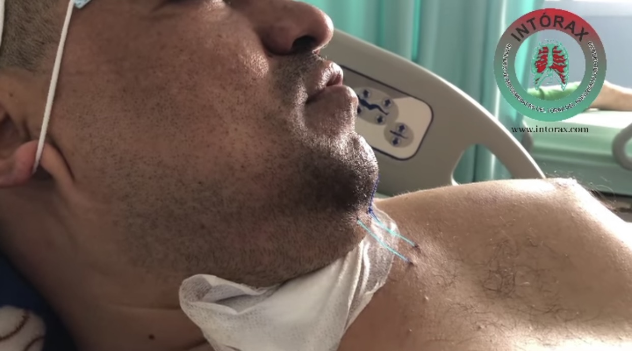RESULTADO CLÍNICO : CASO DE ESTENOSIS TRAQUEAL DE POST ANTERIOR <a href="https://www.facebook.com/hashtag/intorax?__eep__=6&__cft__[0]=AZUPiOghrEHbhm-lPfvpQPDucqG1aybTNkHXLzEFPNP6ebr2tjxr9bEhnrdZldy3OLBQrV0lyB28LhOv-kTl7UWiQCTjOnUS5pGLVVrt-5hoJElny5R1--dm4WVbcoImVvQYdPdmuL8AbexoDOjrOPb_VB8gtMhCOwt34W4vmKawEA&__tn__=*NK-R">#INTORAX</a>+ @intorax.cucuta