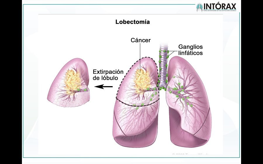 CLASE: “CÁNCER DE PULMÓN” Estudiantes de VIII Semestre UPA, Estudiantes IX Semestre Universidad el Bosque, 4 de Octubre 2021. @intorax.cucuta @unipamplona @departamentodemedicina @uelbosque
