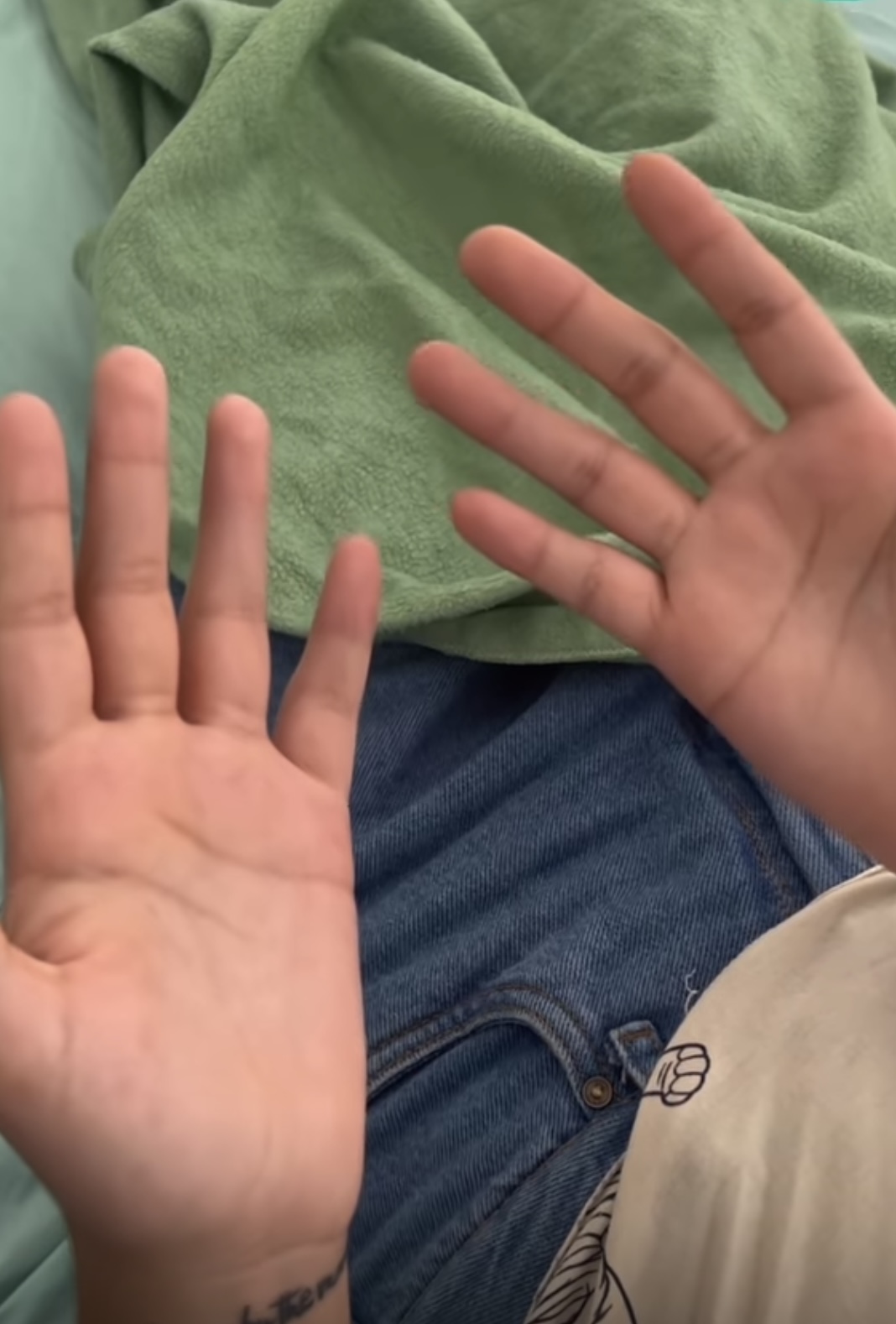 HIPERHIDROSIS PALMAR SEVERA DISFUNCIONAL CURADA!