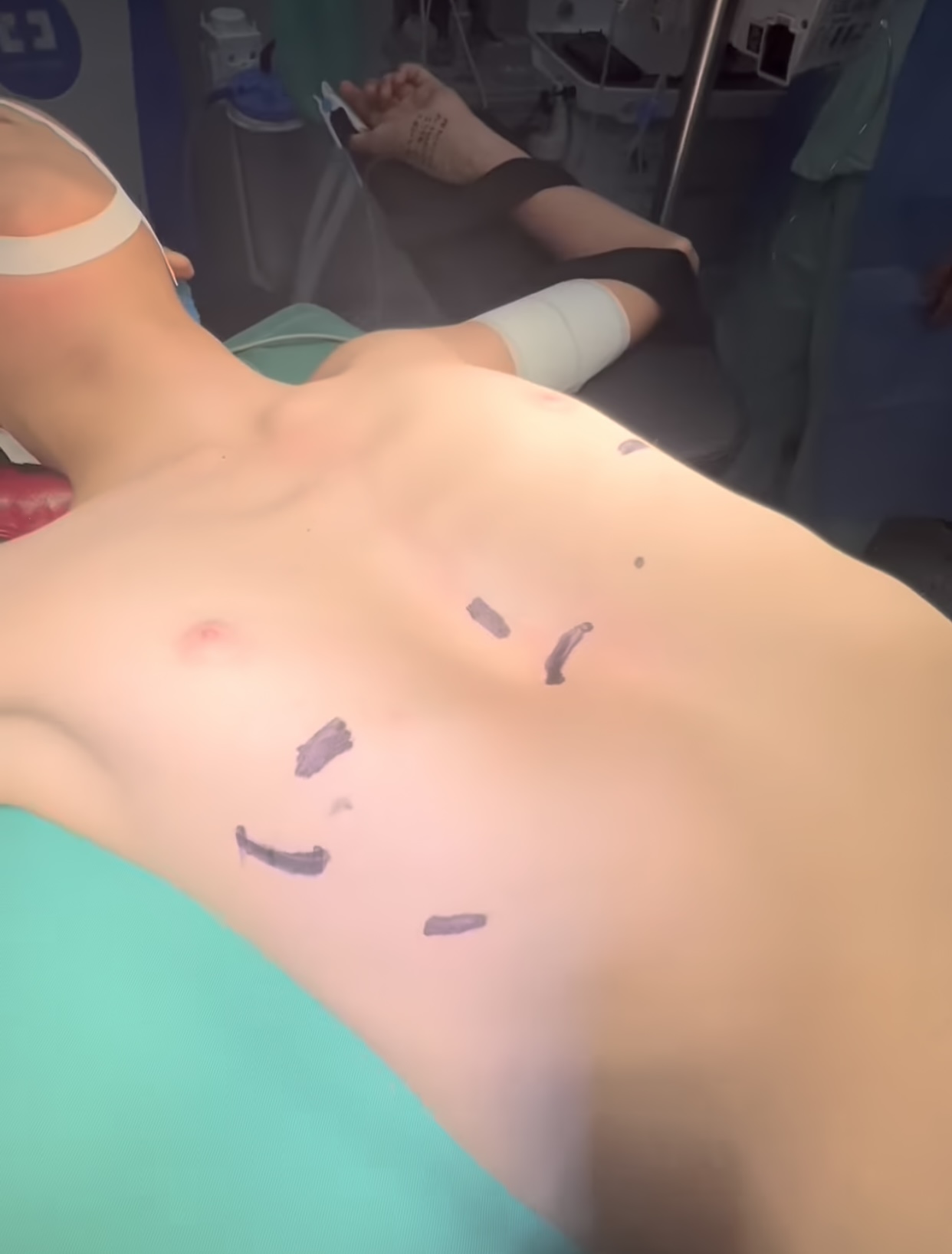 DEFORMIDAD DE PARED DEL TORAX “PECHO HUNDIDO” – PECTUS EXCAVATUM.