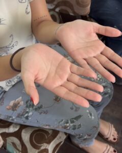 SUDORACIÓN EXCESIVA Y DISFUNCIONAL EN MANOS/HIPERHIDROSIS PALMAR PRIMARIA TRATADA POR CIRUJANO TORÁCICO !